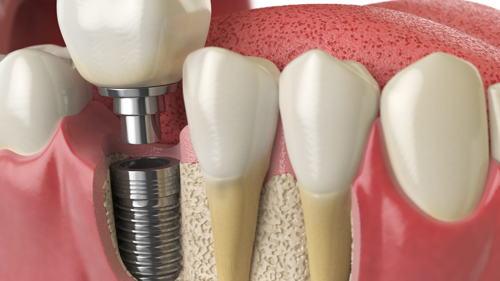 Rendering of dental implant assembly