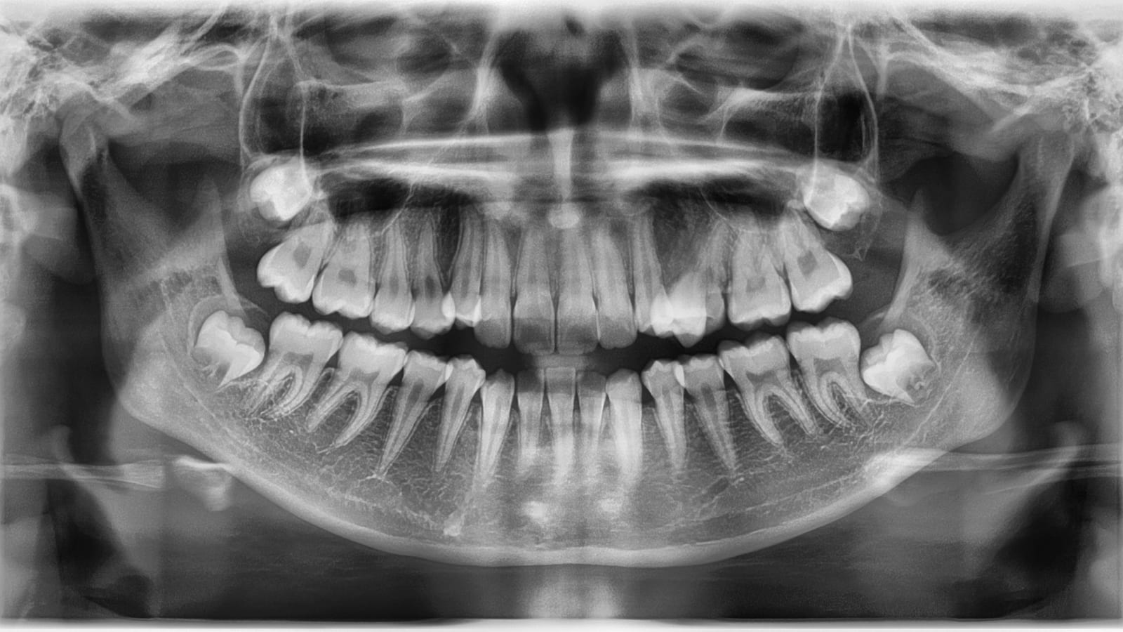 X-Ray Of the Maxillofacial Area