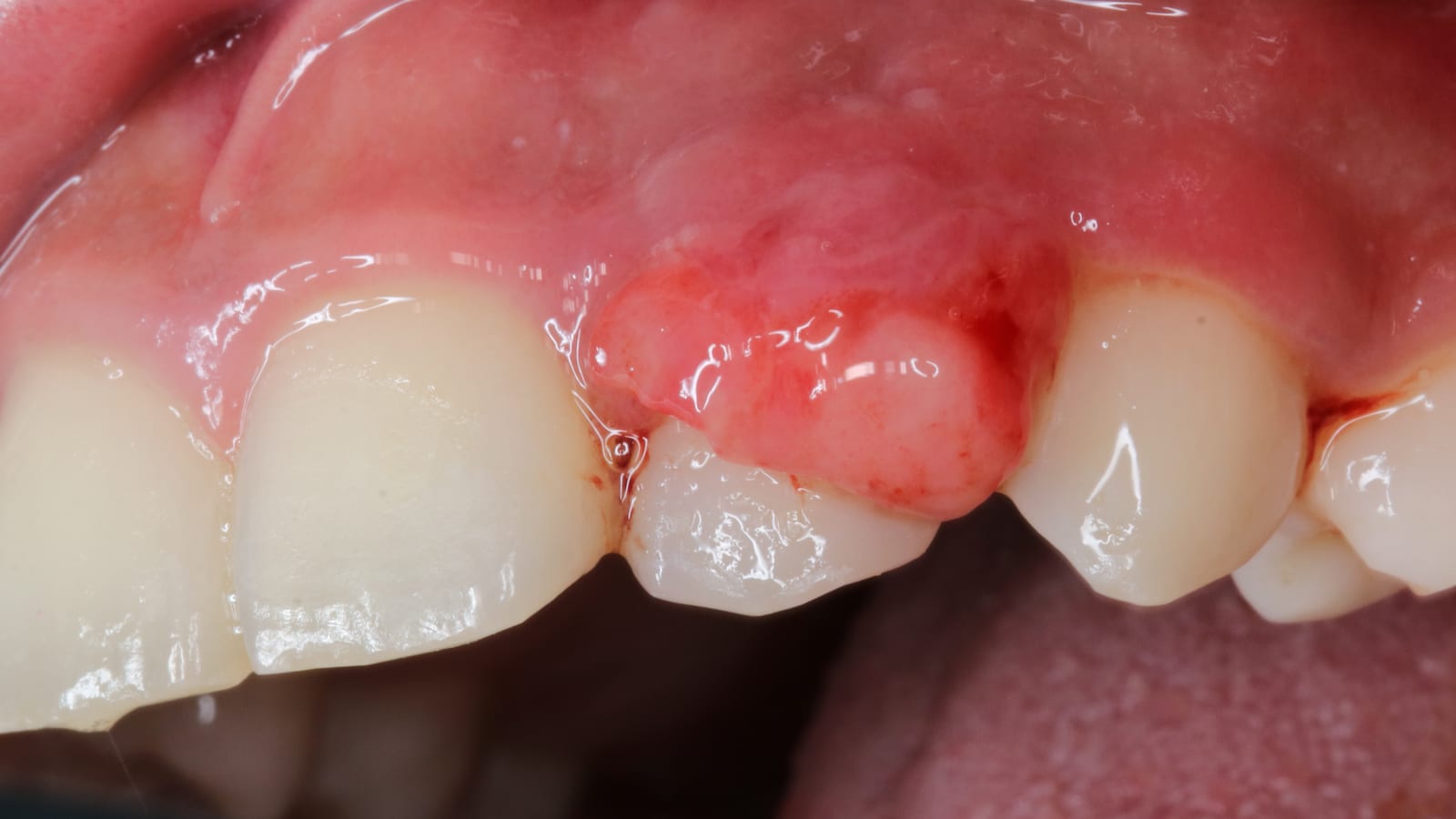 Abnormal growth of the gums over a tooth